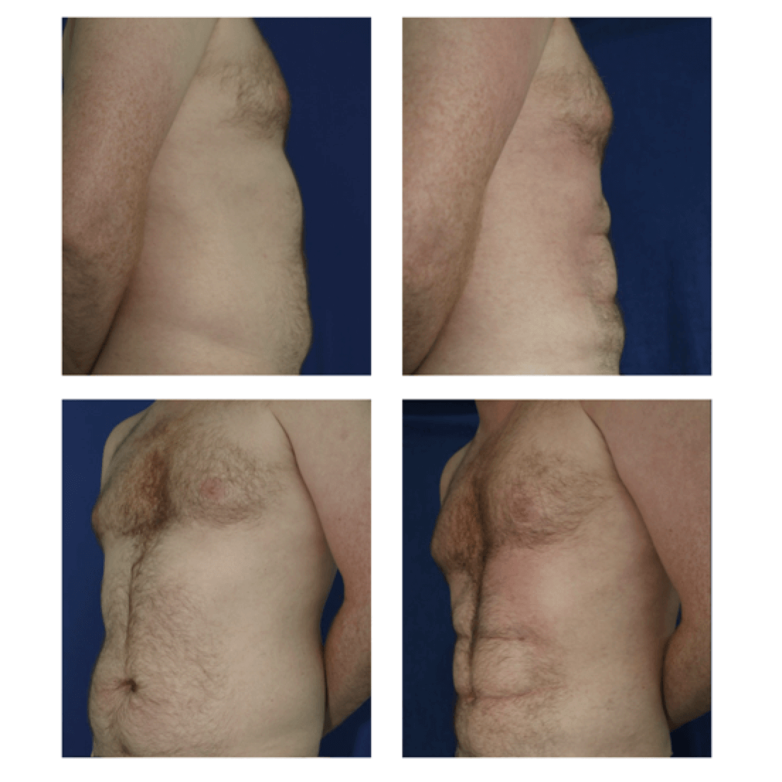 lipo before and after